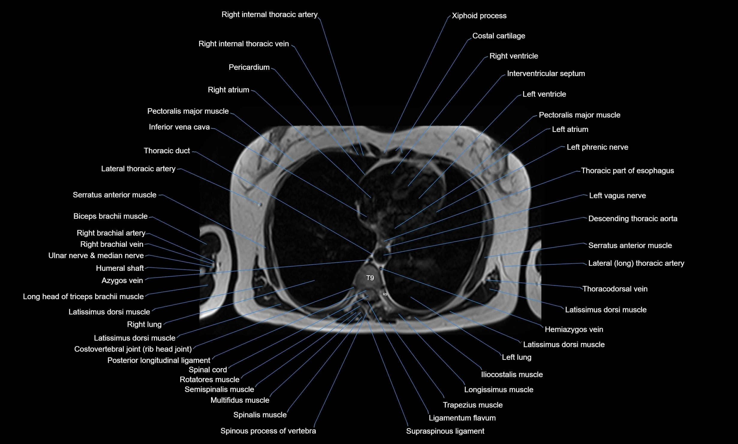 MRI chest axial  cross sectional anatomy 3T radiology  image-img-00001-00030.webp